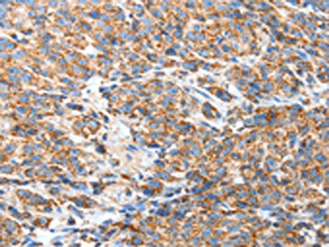 The image on the left is immunohistochemistry of paraffin-embedded Human esophagus cancer tissue using CSB-PA089402(BAK1 Antibody) at dilution 1/50, on the right is treated with fusion protein. (Original magnification: ×200)