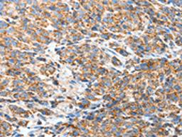 The image on the left is immunohistochemistry of paraffin-embedded Human esophagus cancer tissue using CSB-PA089402(BAK1 Antibody) at dilution 1/50, on the right is treated with fusion protein. (Original magnification: ×200)