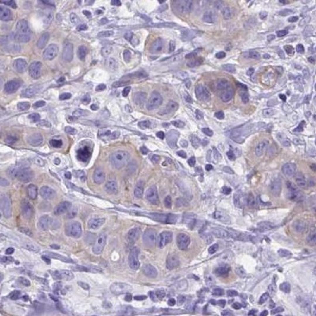 Immunohistochemistry: EPB41L1 Antibody [NBP2-31572] - breast cancer