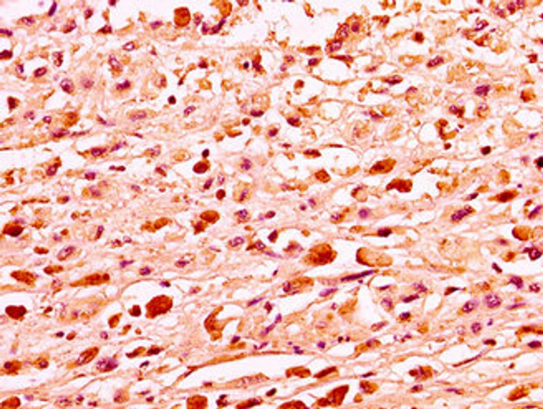 IHC image of CSB-PA010087OA81nme1HU diluted at 1:50 and staining in paraffin-embedded human melanoma performed on a Leica BondTM system. After dewaxing and hydration, antigen retrieval was mediated by high pressure in a citrate buffer (pH 6.0). Section was blocked with 10% normal goat serum 30min at RT. Then primary antibody (1% BSA) was incubated at 4°C overnight. The primary is detected by a biotinylated secondary antibody and visualized using an HRP conjugated SP system.