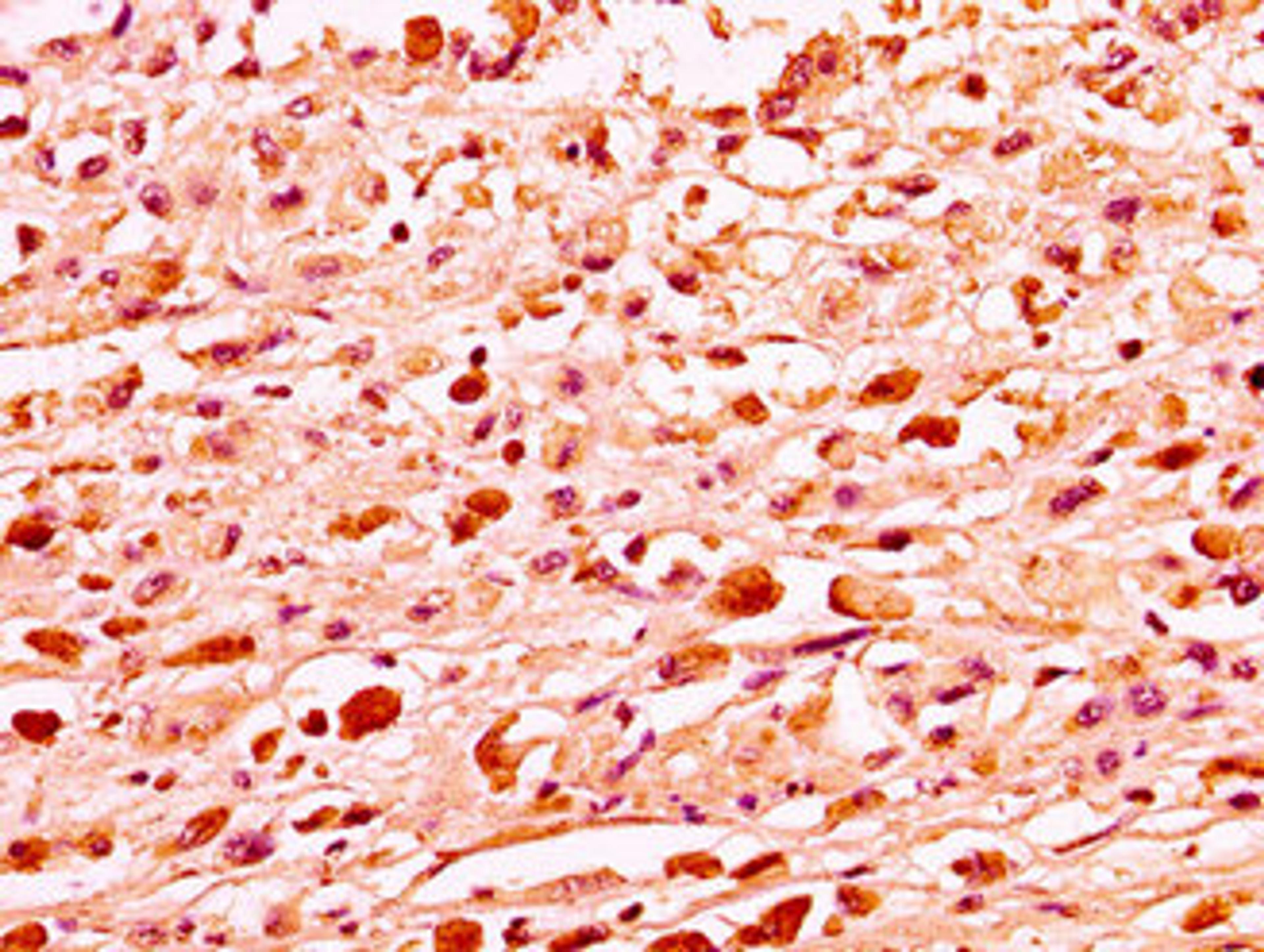 IHC image of CSB-PA010087OA81nme1HU diluted at 1:50 and staining in paraffin-embedded human melanoma performed on a Leica BondTM system. After dewaxing and hydration, antigen retrieval was mediated by high pressure in a citrate buffer (pH 6.0). Section was blocked with 10% normal goat serum 30min at RT. Then primary antibody (1% BSA) was incubated at 4°C overnight. The primary is detected by a biotinylated secondary antibody and visualized using an HRP conjugated SP system.