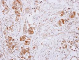 Immunohistochemistry-Paraffin: Guanine deaminase Antibody [NBP2-16769] - Immunohistochemical analysis of paraffin-embedded Breast ca, using antibody at 1:500 dilution.