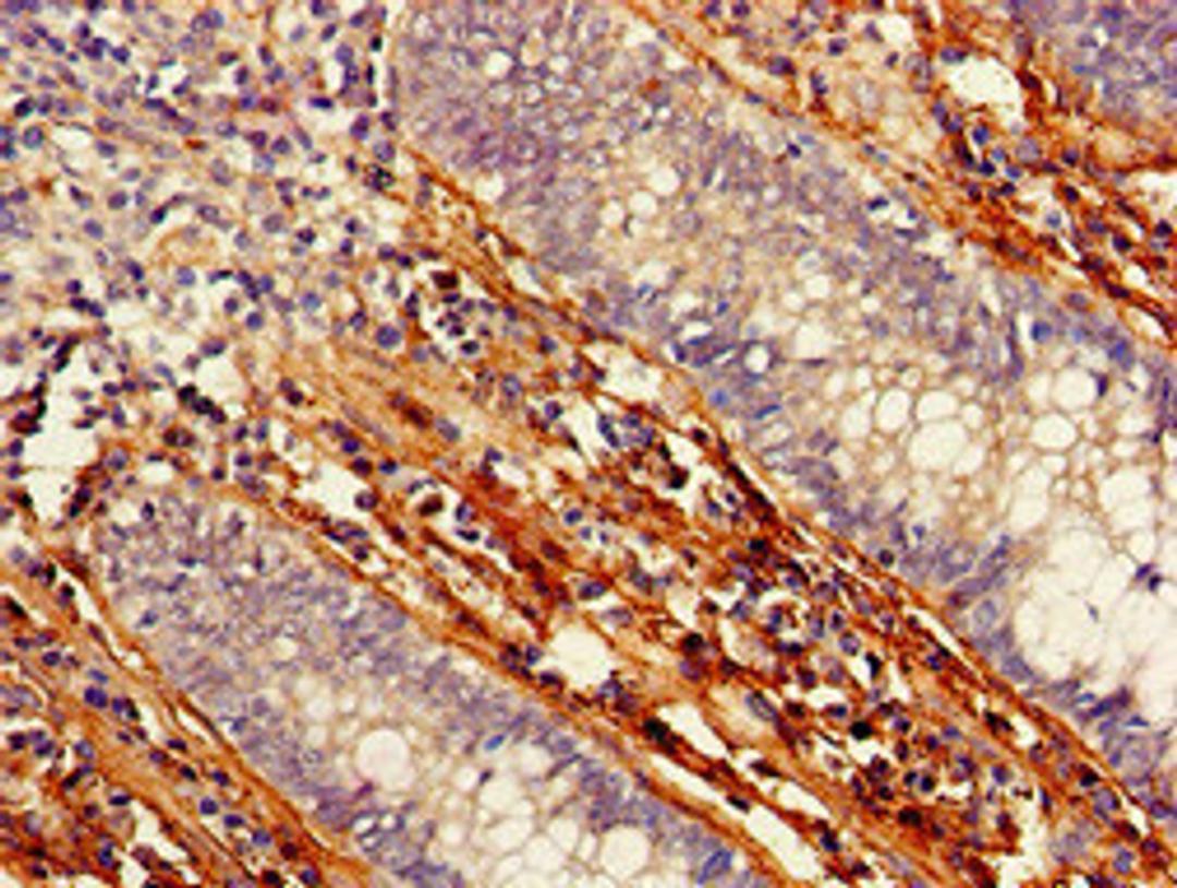 Immunohistochemistry of paraffin-embedded human colon cancer using CSB-PA623823LA01HU at dilution of 1:100