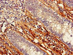 Immunohistochemistry of paraffin-embedded human colon cancer using CSB-PA623823LA01HU at dilution of 1:100