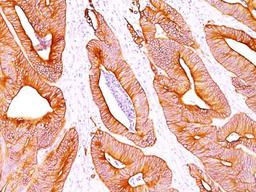 Immunohistochemistry-Paraffin: pan Cytokeratin Antibody (AE1 + AE3) [NBP2-29429] - Formalin-paraffin colon carcinoma stained with pan Cytokeratin Ab cocktail (AE-1 / AE3).