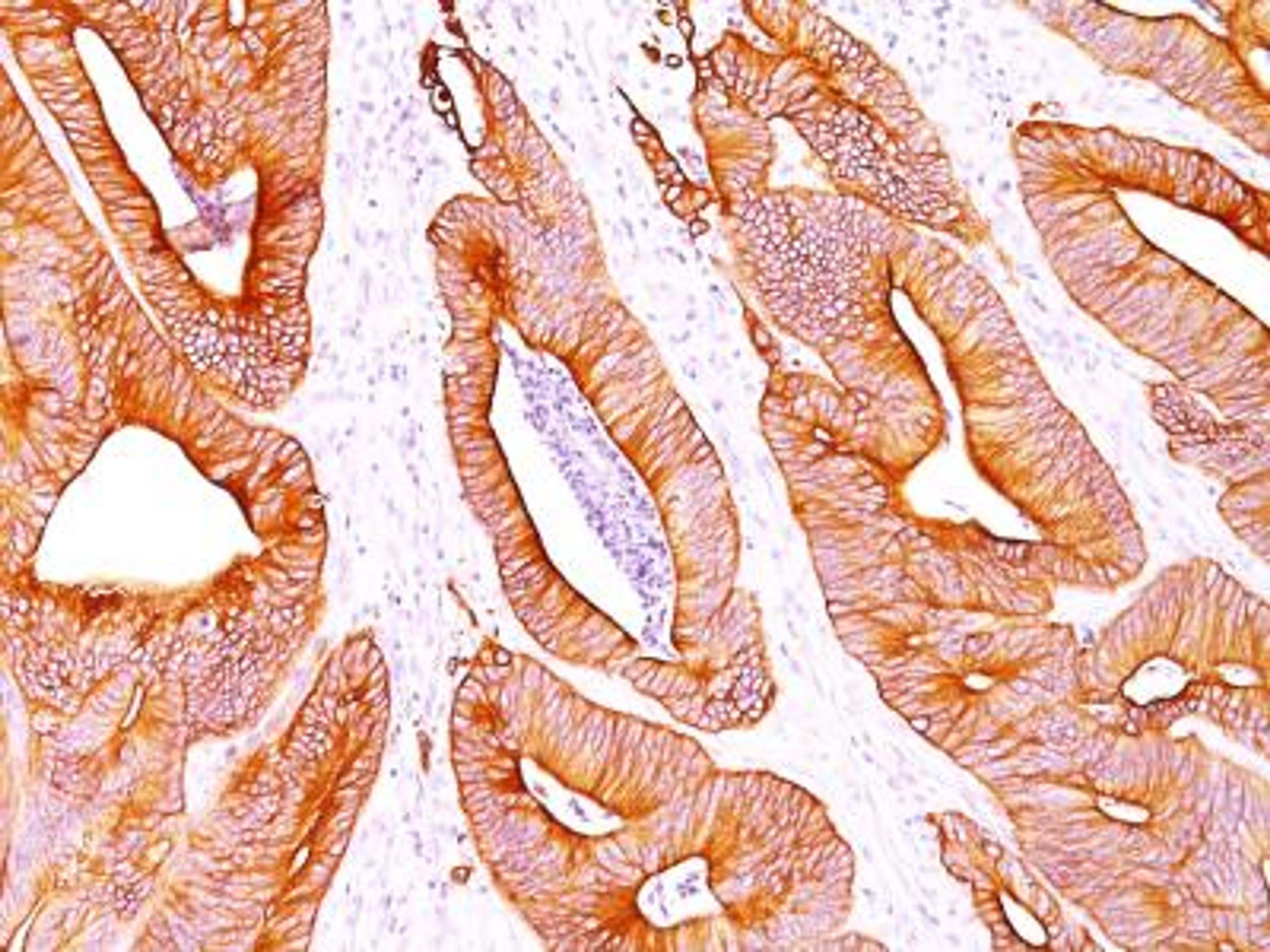 Immunohistochemistry-Paraffin: pan Cytokeratin Antibody (AE1 + AE3) [NBP2-29429] - Formalin-paraffin colon carcinoma stained with pan Cytokeratin Ab cocktail (AE-1 / AE3).