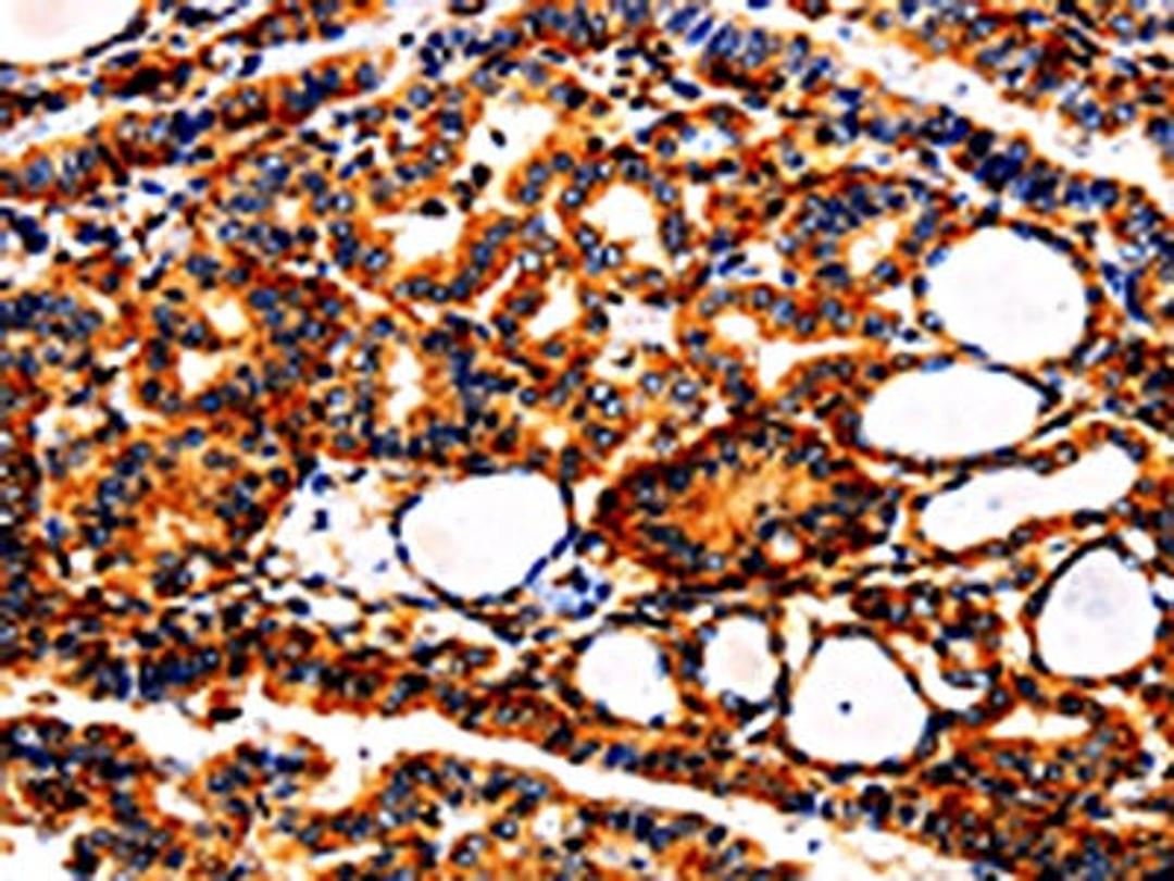 The image is immunohistochemistry of paraffin-embedded Human thyroid cancer tissue using CSB-PA236485(APLP1 Antibody) at dilution 1/25. (Original magnification: ×200)