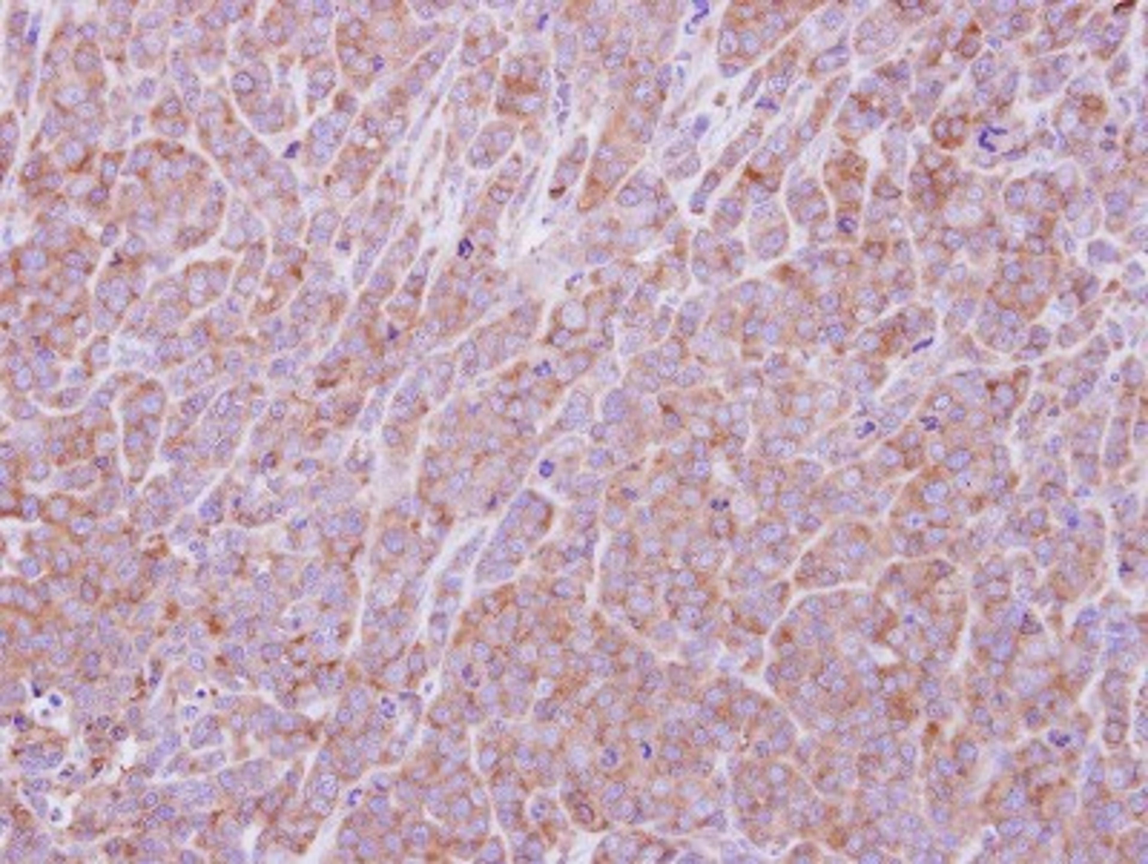 Immunohistochemistry-Paraffin: eIF2B1 Antibody [NBP2-16292] - Immunohistochemical analysis of paraffin-embedded BT483 xenograft, using antibody at 1:500 dilution.