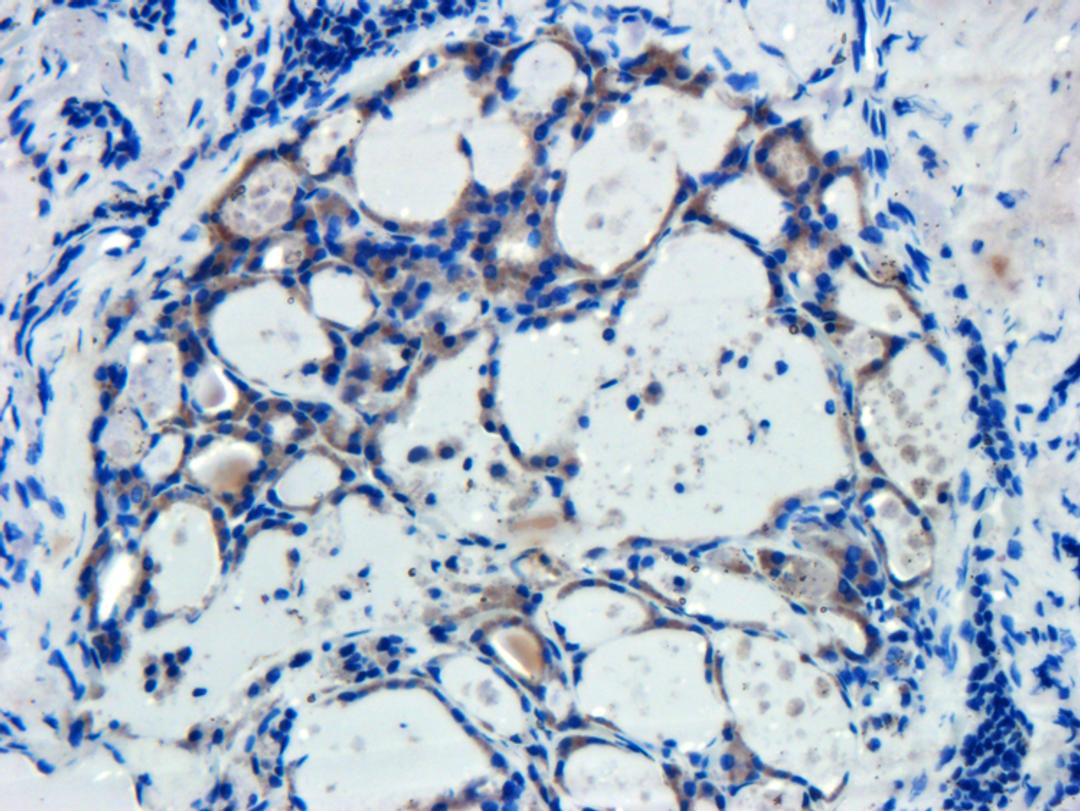 Immunohistochemical staining of human breast cancer tissue using beta actin antibody (dilution of primary antibody - 1:200)