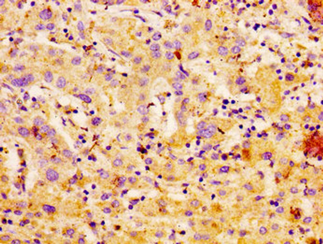 IHC image of CSB-PA004372LA01HU diluted at 1:100 and staining in paraffin-embedded human liver cancer performed on a Leica BondTM system. After dewaxing and hydration, antigen retrieval was mediated by high pressure in a citrate buffer (pH 6.0). Section was blocked with 10% normal goat serum 30min at RT. Then primary antibody (1% BSA) was incubated at 4°C overnight. The primary is detected by a biotinylated secondary antibody and visualized using an HRP conjugated SP system.