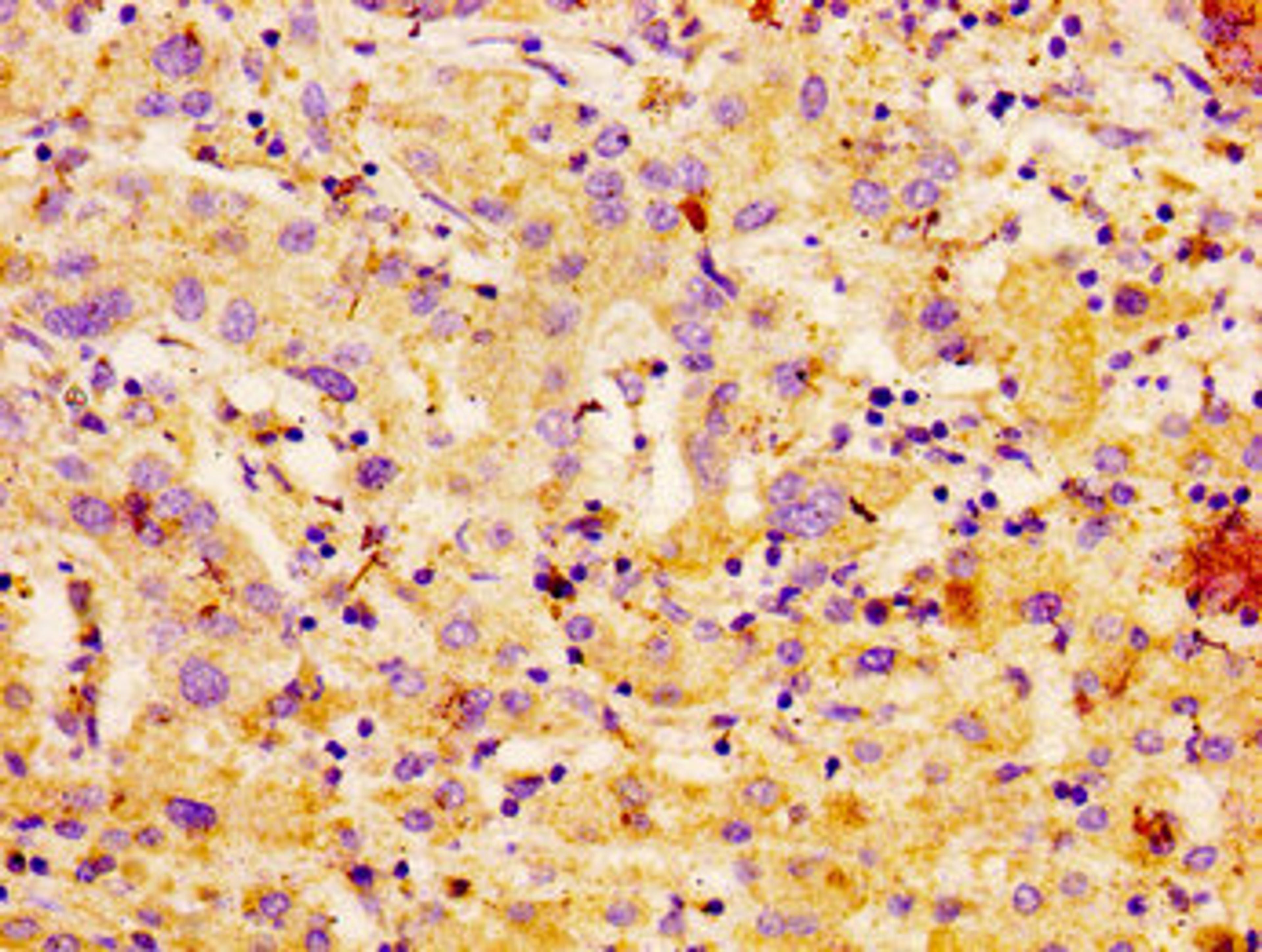 IHC image of CSB-PA004372LA01HU diluted at 1:100 and staining in paraffin-embedded human liver cancer performed on a Leica BondTM system. After dewaxing and hydration, antigen retrieval was mediated by high pressure in a citrate buffer (pH 6.0). Section was blocked with 10% normal goat serum 30min at RT. Then primary antibody (1% BSA) was incubated at 4°C overnight. The primary is detected by a biotinylated secondary antibody and visualized using an HRP conjugated SP system.