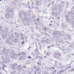 Immunohistochemistry: SLC4A4 Antibody [NBP2-32020] - breast cancer