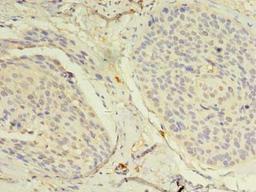 Immunohistochemistry of paraffin-embedded human cervical cancer using CSB-PA887033LA01HU at dilution of 1:100