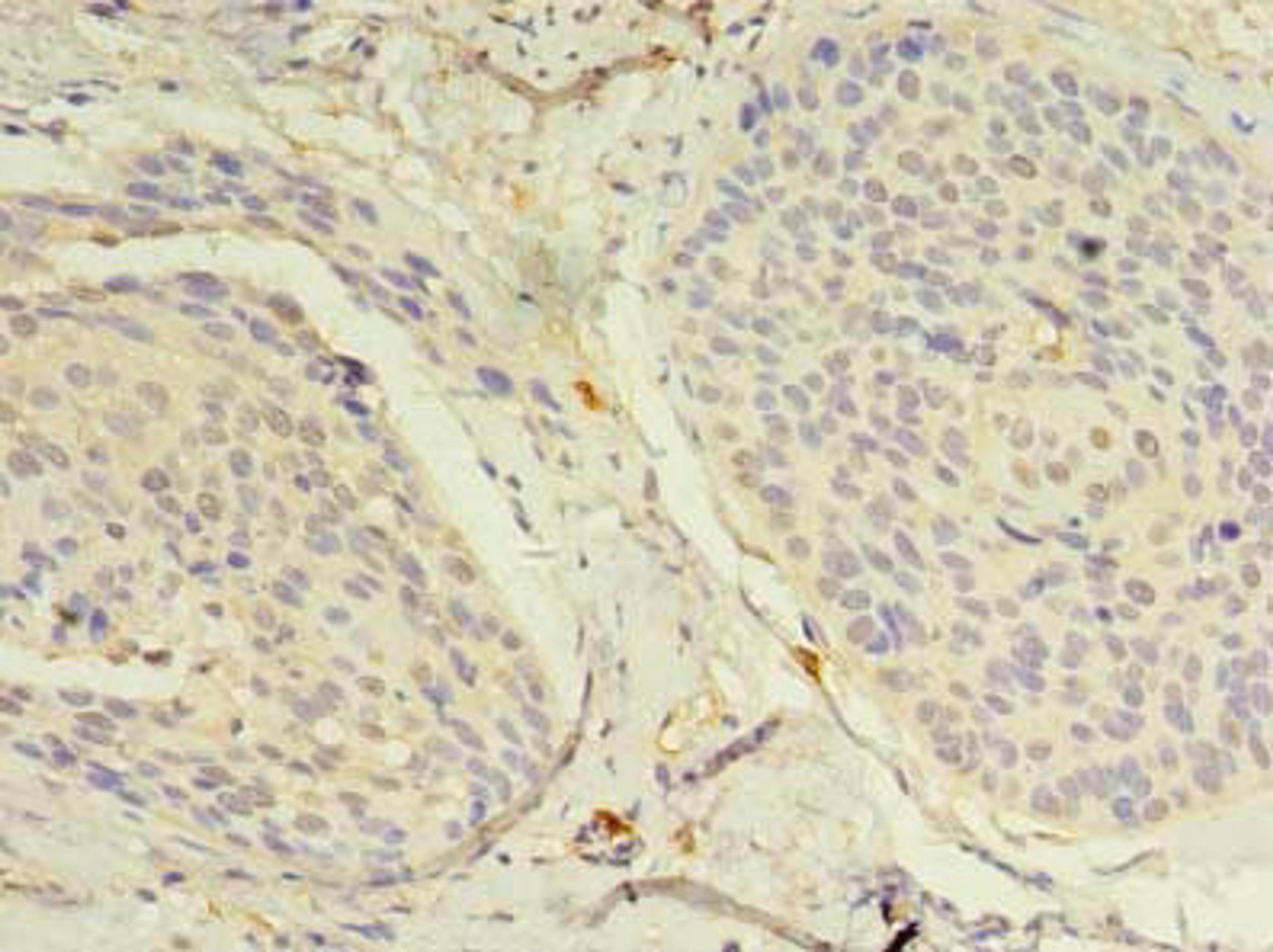 Immunohistochemistry of paraffin-embedded human cervical cancer using CSB-PA887033LA01HU at dilution of 1:100