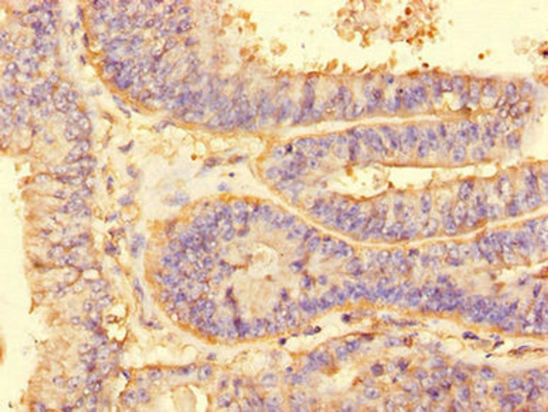 Immunohistochemistry of paraffin-embedded human endometrial cancer using CSB-PA863983LA01HU at dilution of 1:100