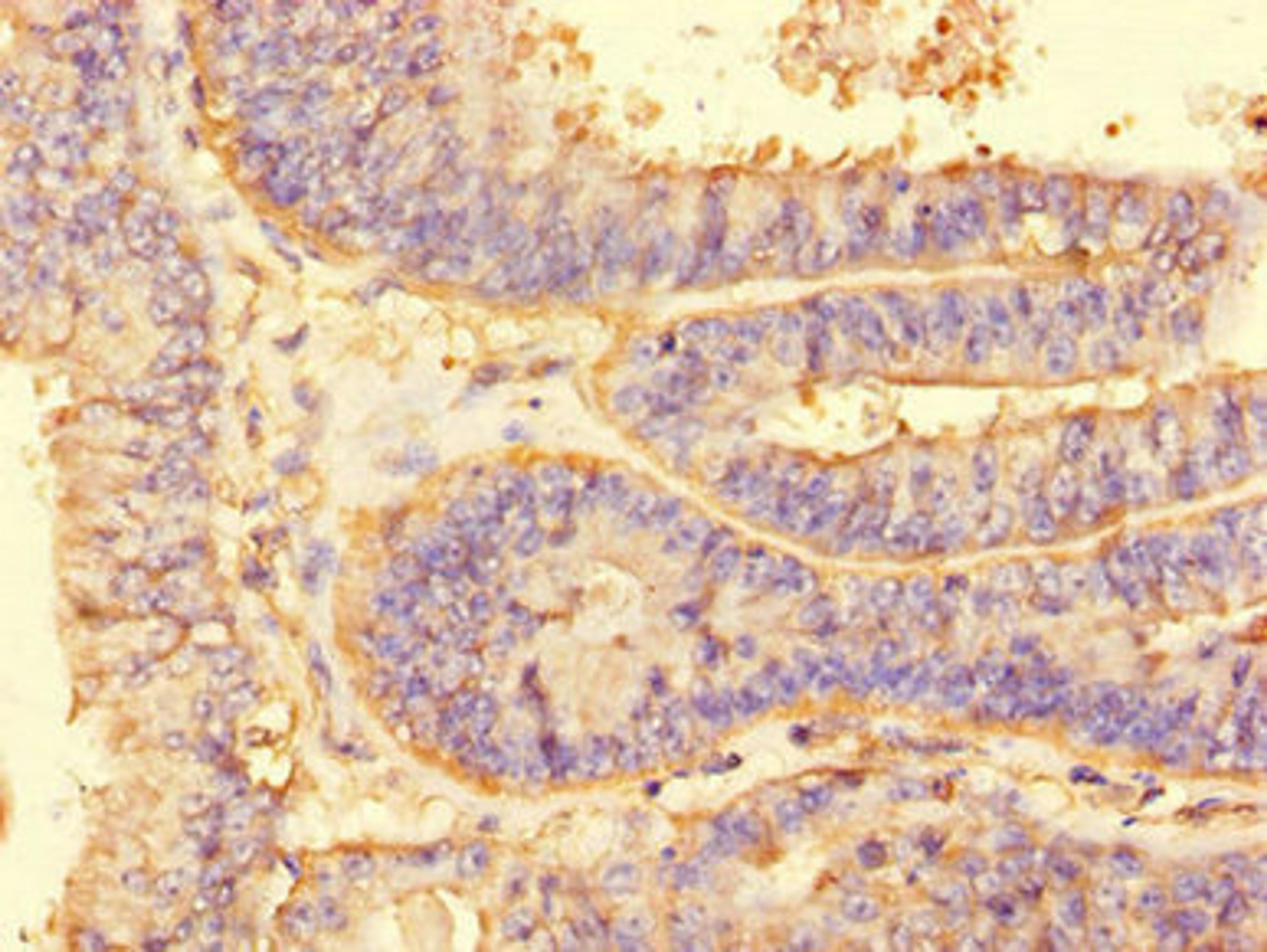 Immunohistochemistry of paraffin-embedded human endometrial cancer using CSB-PA863983LA01HU at dilution of 1:100
