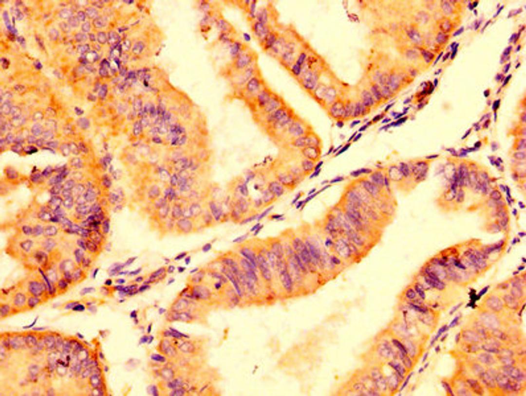 IHC image of CSB-PA22439A0Rb diluted at 1:500 and staining in paraffin-embedded human endometrial cancer performed on a Leica BondTM system. After dewaxing and hydration, antigen retrieval was mediated by high pressure in a citrate buffer (pH 6.0). Section was blocked with 10% normal goat serum 30min at RT. Then primary antibody (1% BSA) was incubated at 4&deg;C overnight. The primary is detected by a biotinylated secondary antibody and visualized using an HRP conjugated SP system.