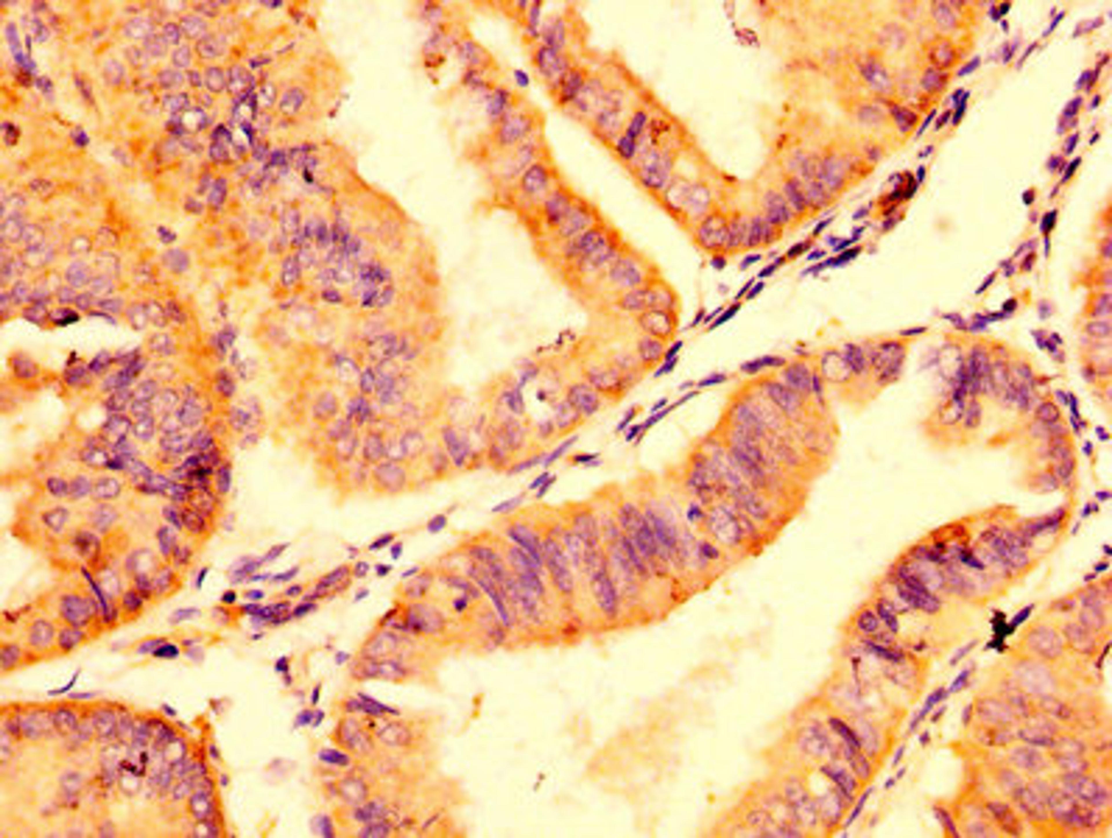 IHC image of CSB-PA22439A0Rb diluted at 1:500 and staining in paraffin-embedded human endometrial cancer performed on a Leica BondTM system. After dewaxing and hydration, antigen retrieval was mediated by high pressure in a citrate buffer (pH 6.0). Section was blocked with 10% normal goat serum 30min at RT. Then primary antibody (1% BSA) was incubated at 4&deg;C overnight. The primary is detected by a biotinylated secondary antibody and visualized using an HRP conjugated SP system.