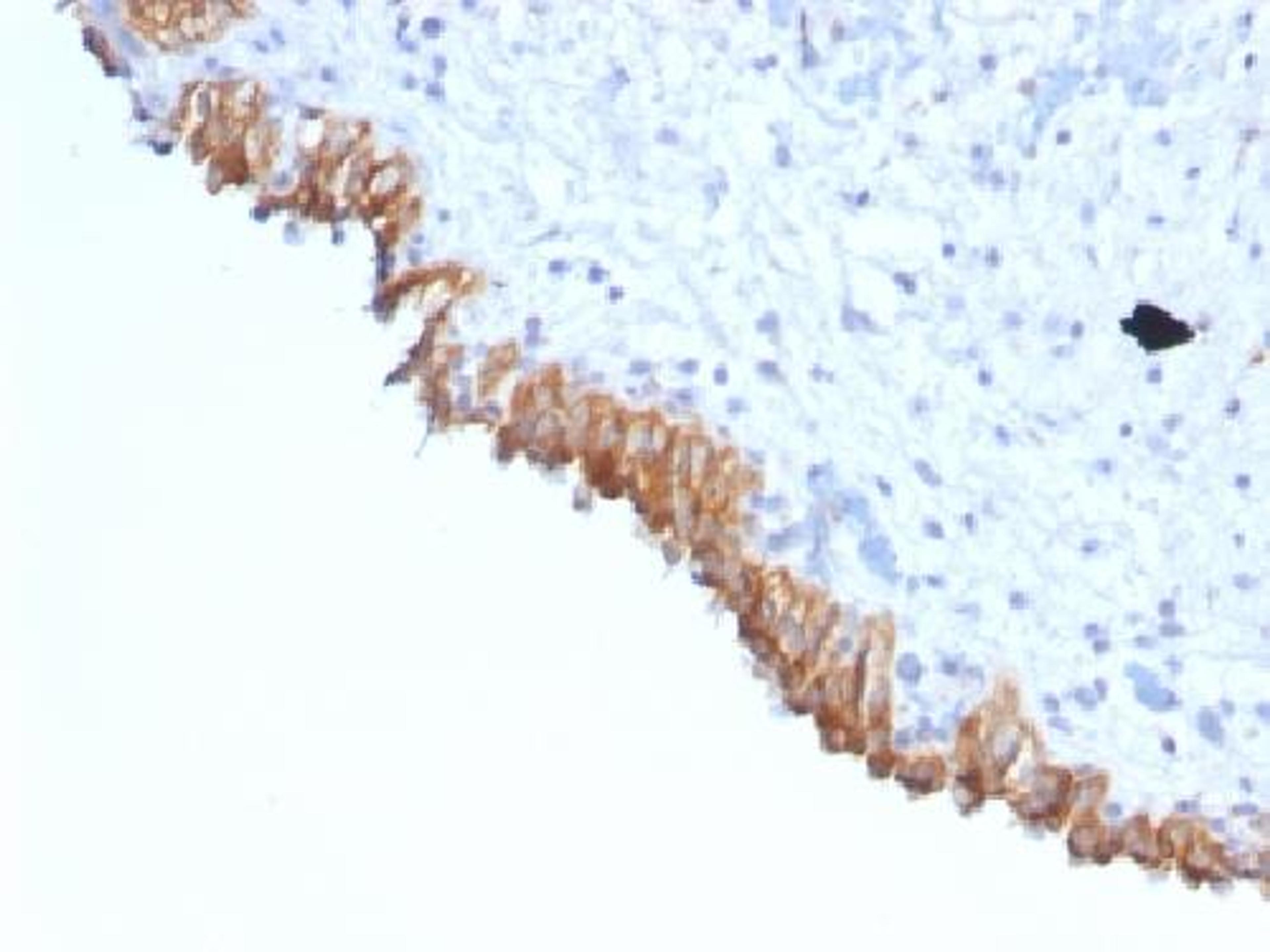 Immunohistochemical staining of human Colon carcinoma tissue using Lewis Y antibody