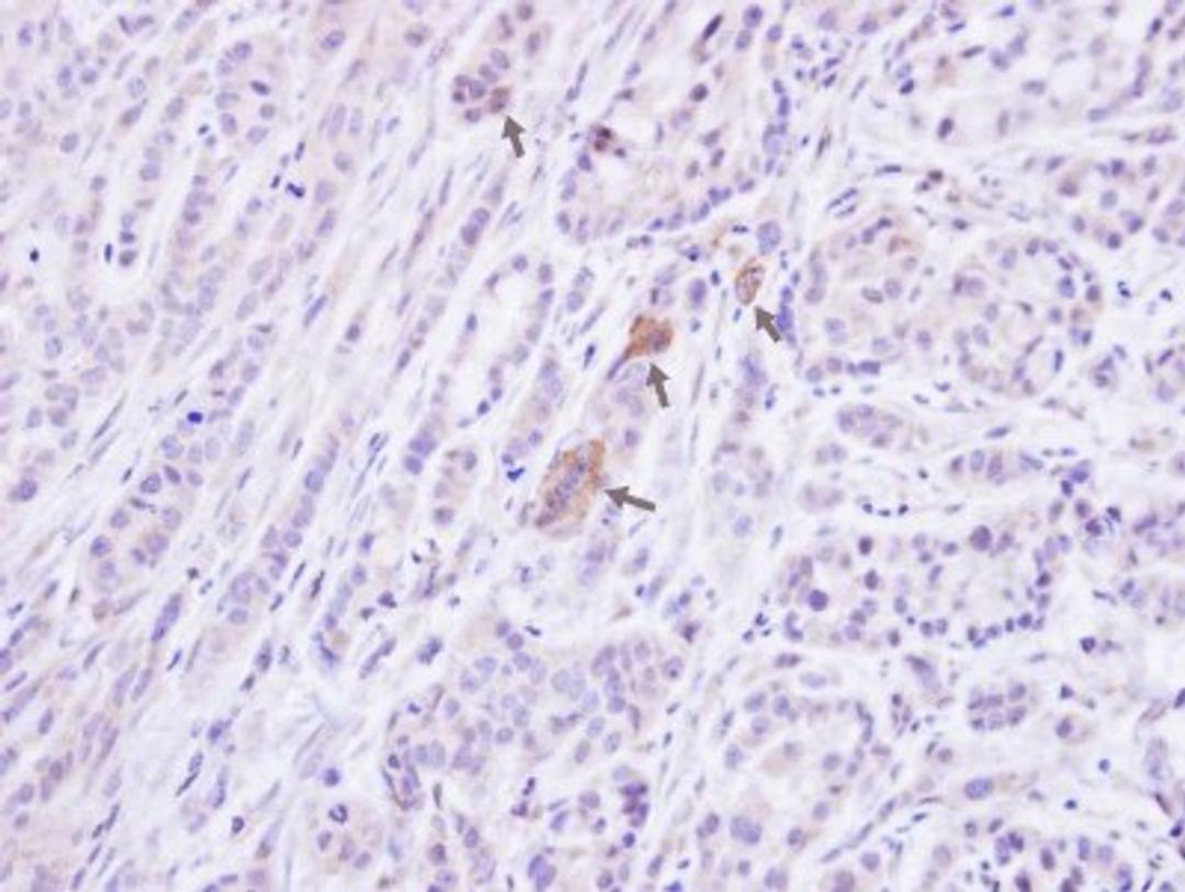 Immunohistochemistry-Paraffin: Protein Phosphatase 1 beta Antibody [NBP1-32618] - Paraffin-embedded A549 xenograft, using antibody at 1:100 dilution.