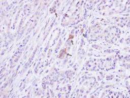 Immunohistochemistry-Paraffin: Protein Phosphatase 1 beta Antibody [NBP1-32618] - Paraffin-embedded A549 xenograft, using antibody at 1:100 dilution.