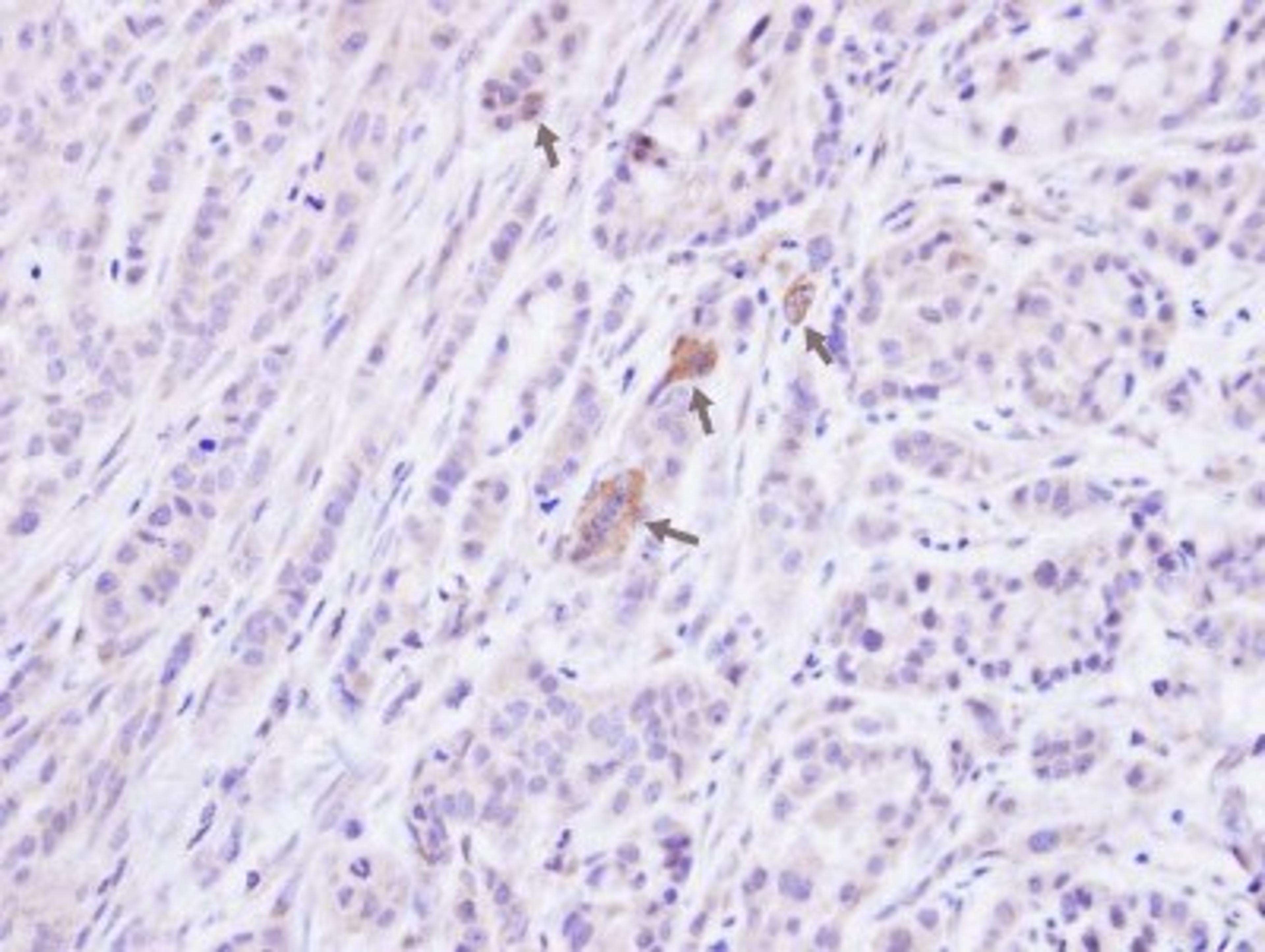 Immunohistochemistry-Paraffin: Protein Phosphatase 1 beta Antibody [NBP1-32618] - Paraffin-embedded A549 xenograft, using antibody at 1:100 dilution.