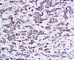 IHC-P of human gastric cancer tissue (B7H4 antibody at 1:400)