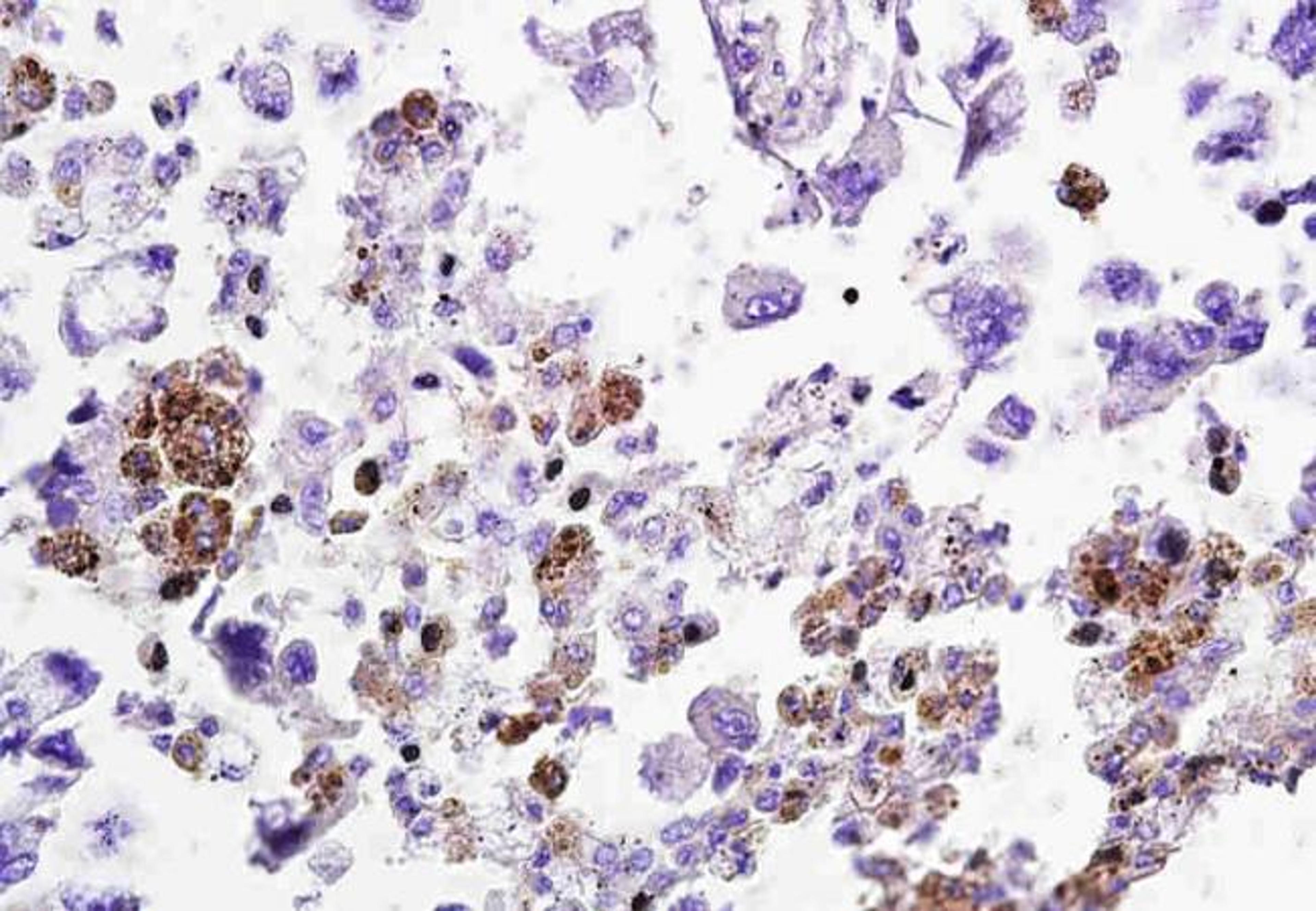 IHC-P of human lung cancer using KLK4 antibody.