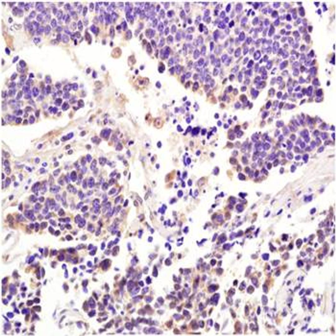 Paraffin-embedded human lung carcinoma fixed with 4% paraformaldehyde. Antigen retrieval by boiling with citrate buffer. Blocking buffer is goat serum (37 degrees for 20 min.). Integrin alpha 7 antibody at 1:200 dilution with overnight incubation at 4 deg