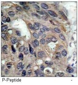 Immunohistochemical analysis of paraffin-embedded human breast carcinoma tissue using Src (phospho-Tyr529) antibody