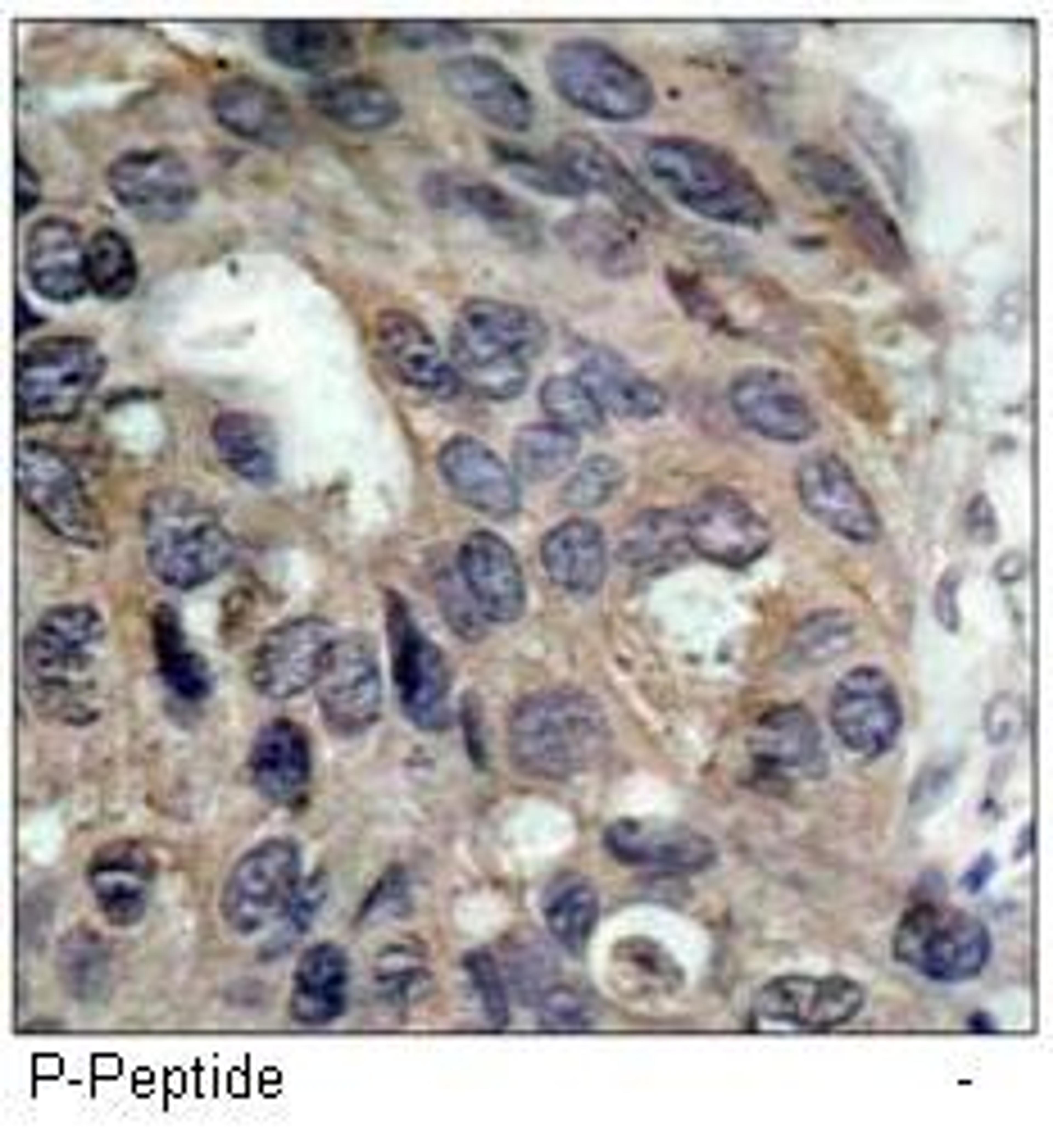 Immunohistochemical analysis of paraffin-embedded human breast carcinoma tissue using Src (phospho-Tyr529) antibody