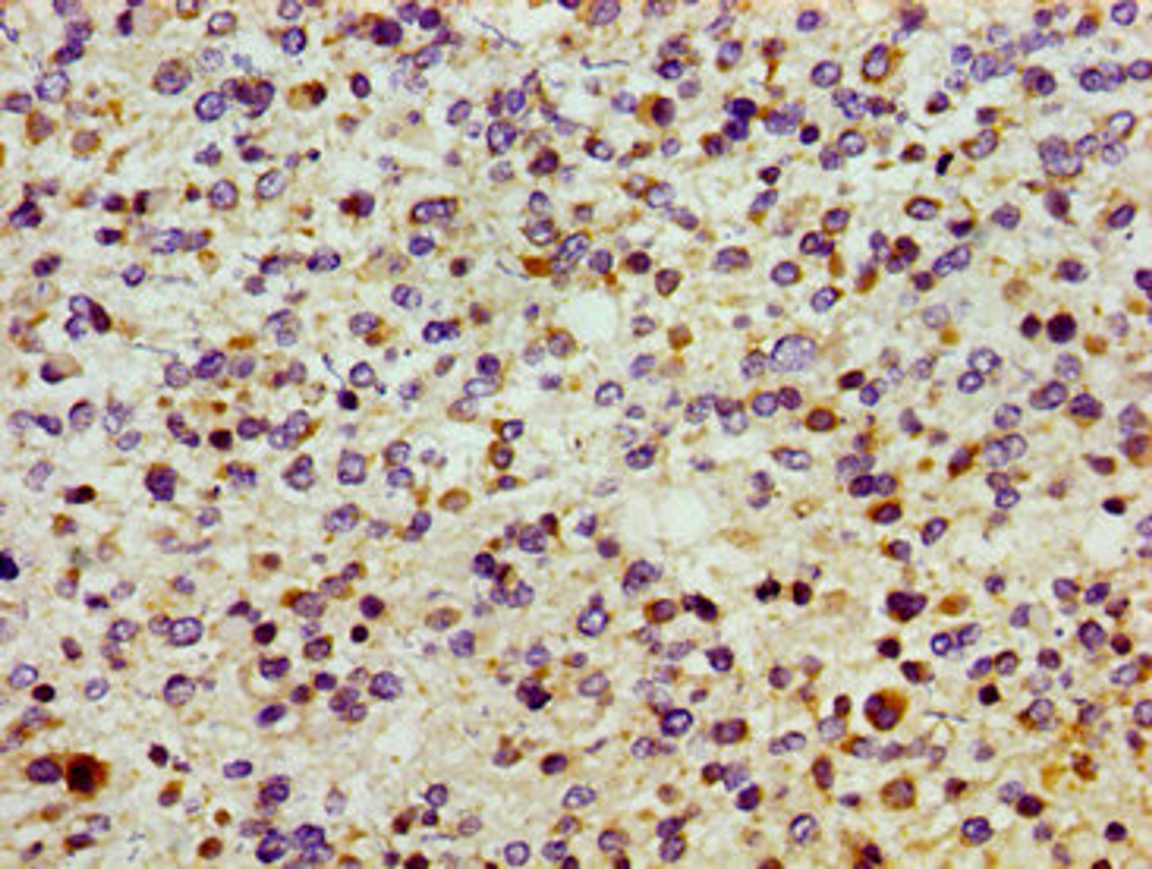 Immunohistochemistry of paraffin-embedded human glioma using CSB-PA021844LA01HU at dilution of 1:100