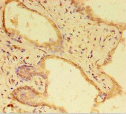 Immunohistochemistry of paraffin-embedded human prostate cancer using CSB-PA821675HA01HU at dilution of 1:100