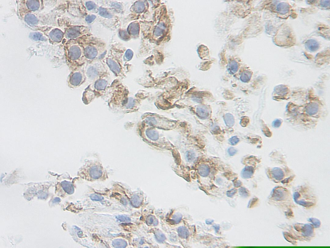 This antibody stained formalin-fixed, paraffin-embedded sections of human renal cell carcinoma. The recommended concentration is 2.5 ug/ml- 1.5 ug/ml with an overnight incubation at 4°C. An HRP-labeled polymer detection system was used with a DAB chromo
