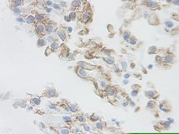This antibody stained formalin-fixed, paraffin-embedded sections of human renal cell carcinoma. The recommended concentration is 2.5 ug/ml- 1.5 ug/ml with an overnight incubation at 4°C. An HRP-labeled polymer detection system was used with a DAB chromo