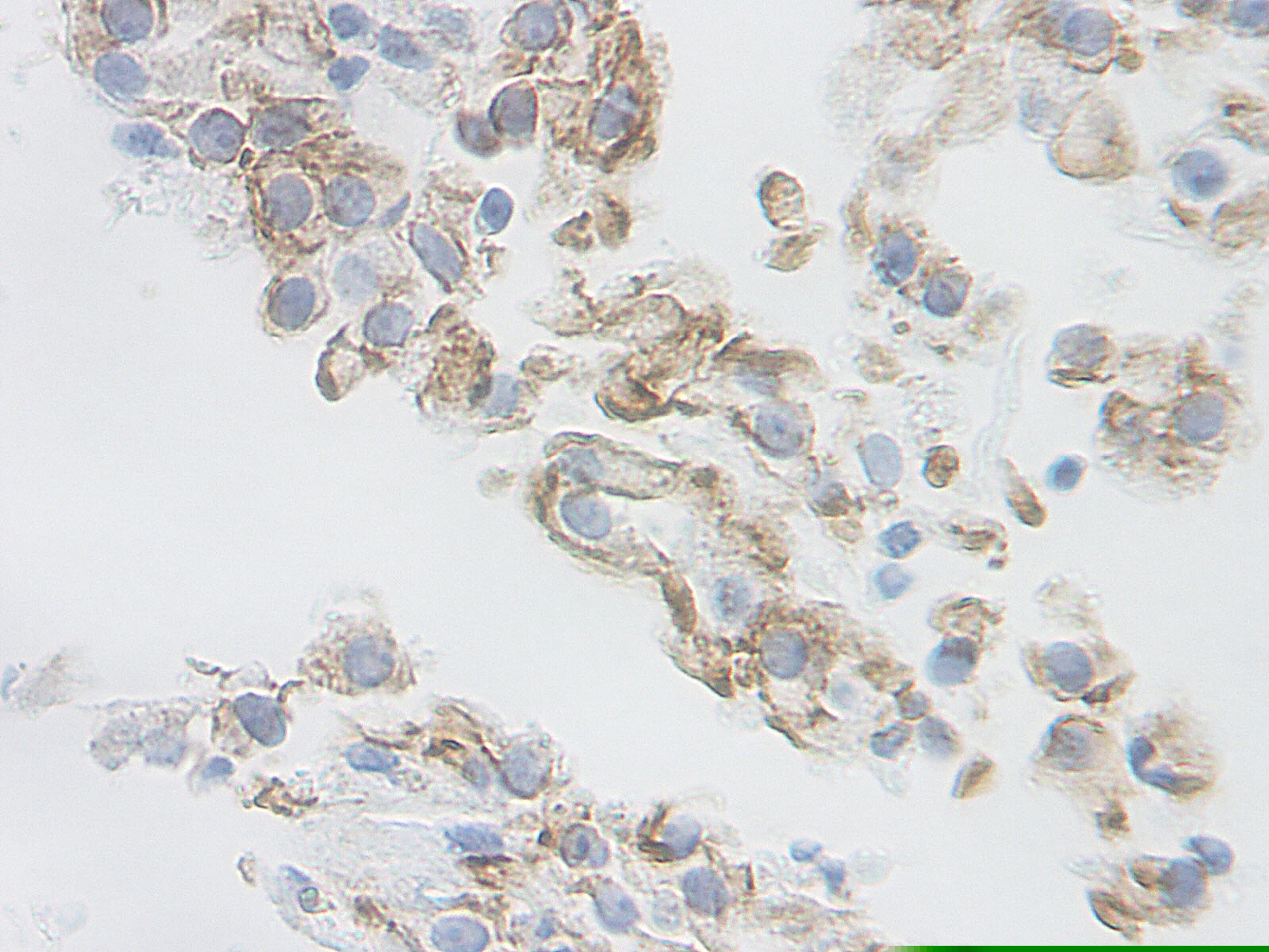 This antibody stained formalin-fixed, paraffin-embedded sections of human renal cell carcinoma. The recommended concentration is 2.5 ug/ml- 1.5 ug/ml with an overnight incubation at 4°C. An HRP-labeled polymer detection system was used with a DAB chromo