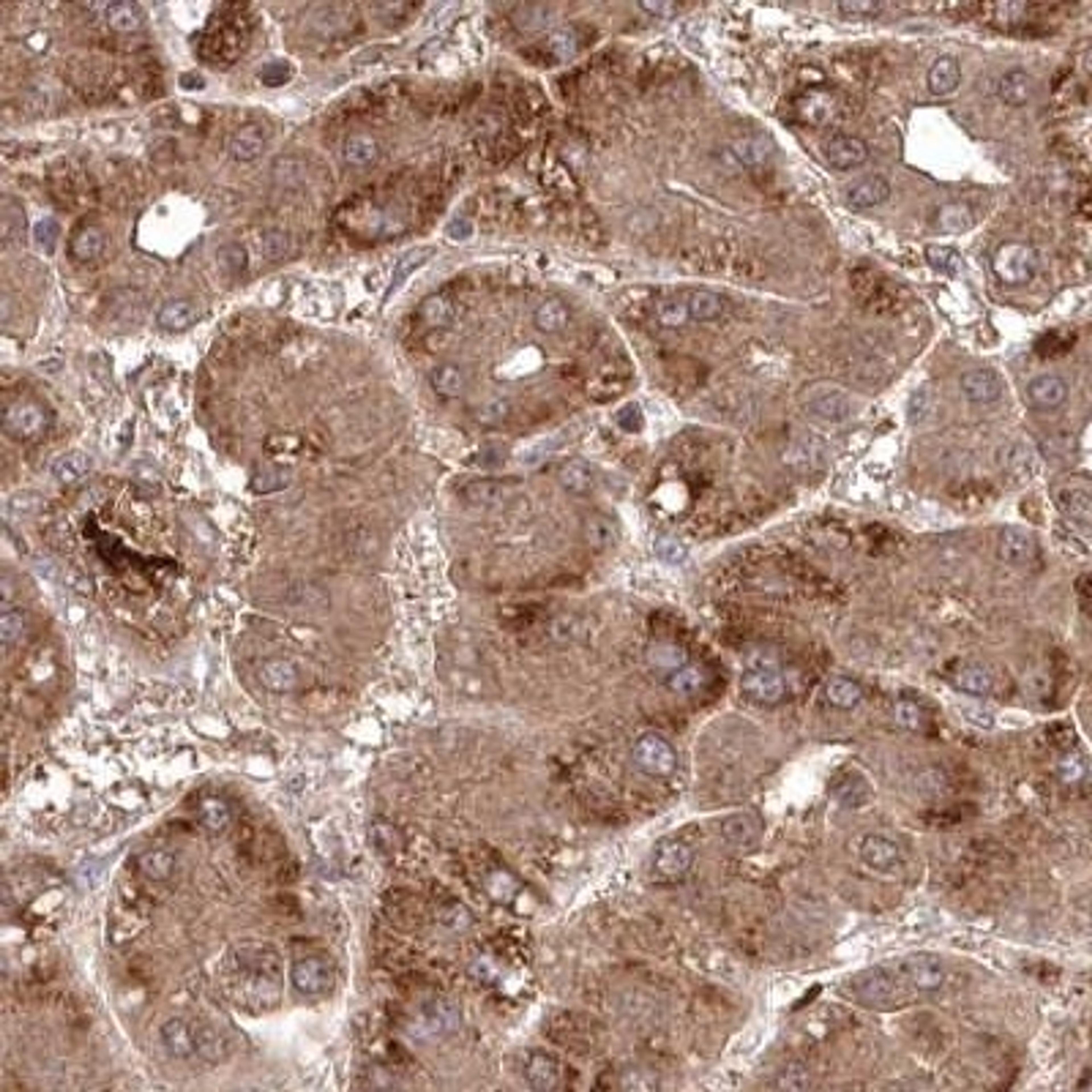 Immunohistochemistry: FBXL17 Antibody [NBP2-32663] - liver cancer