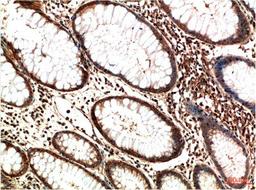 Immunohistochemical analysis of paraffin-embedded Human Colon Carcinoma Tissue using ATM Mouse mAb diluted at 1:200.