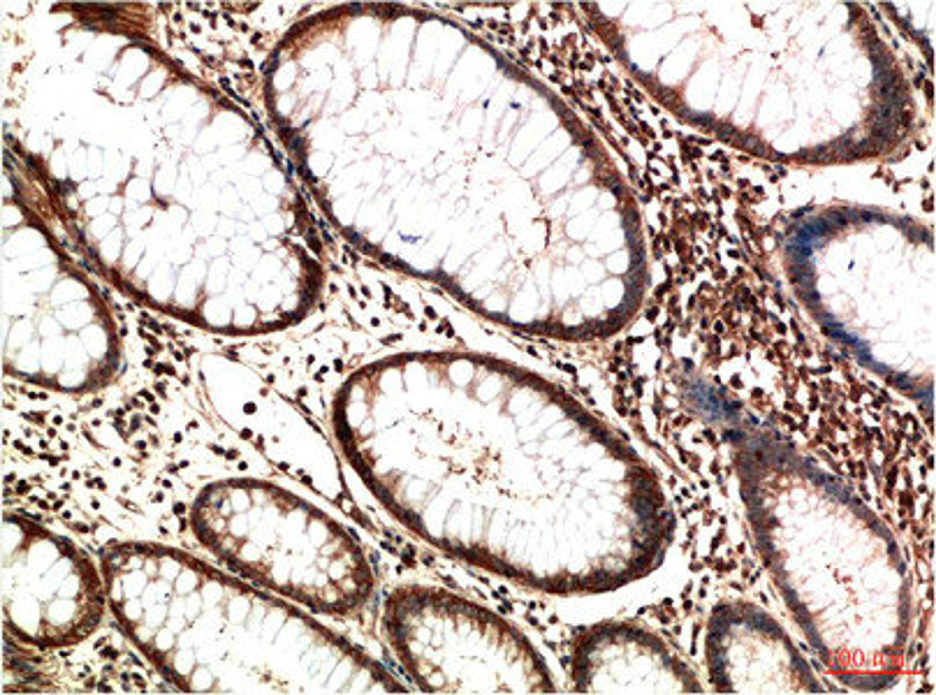 Immunohistochemical analysis of paraffin-embedded Human Colon Carcinoma Tissue using ATM Mouse mAb diluted at 1:200.