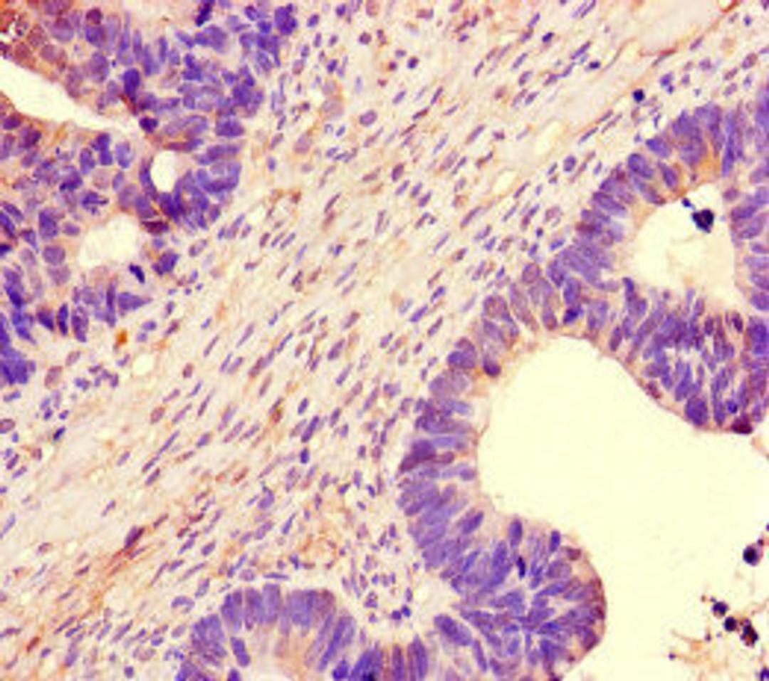 Immunohistochemistry of paraffin-embedded human ovarian cancer using CSB-PA751159LA01HU at dilution of 1:100