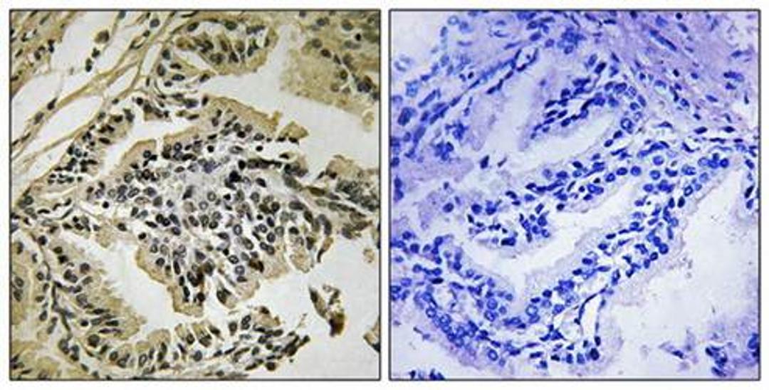 Immunohistochemical analysis of formalin-fixed and paraffin-embedded human prostate carcinoma tissue using PEK-PERK (phospho-Thr981) antibody