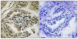 Immunohistochemical analysis of formalin-fixed and paraffin-embedded human prostate carcinoma tissue using PEK-PERK (phospho-Thr981) antibody