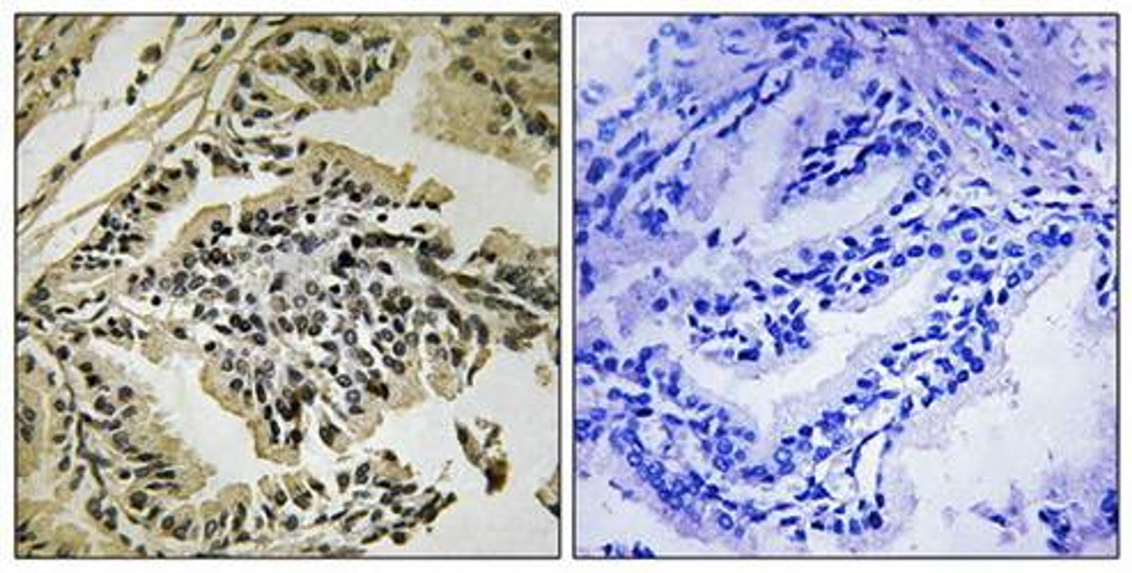 Immunohistochemical analysis of formalin-fixed and paraffin-embedded human prostate carcinoma tissue using PEK-PERK (phospho-Thr981) antibody