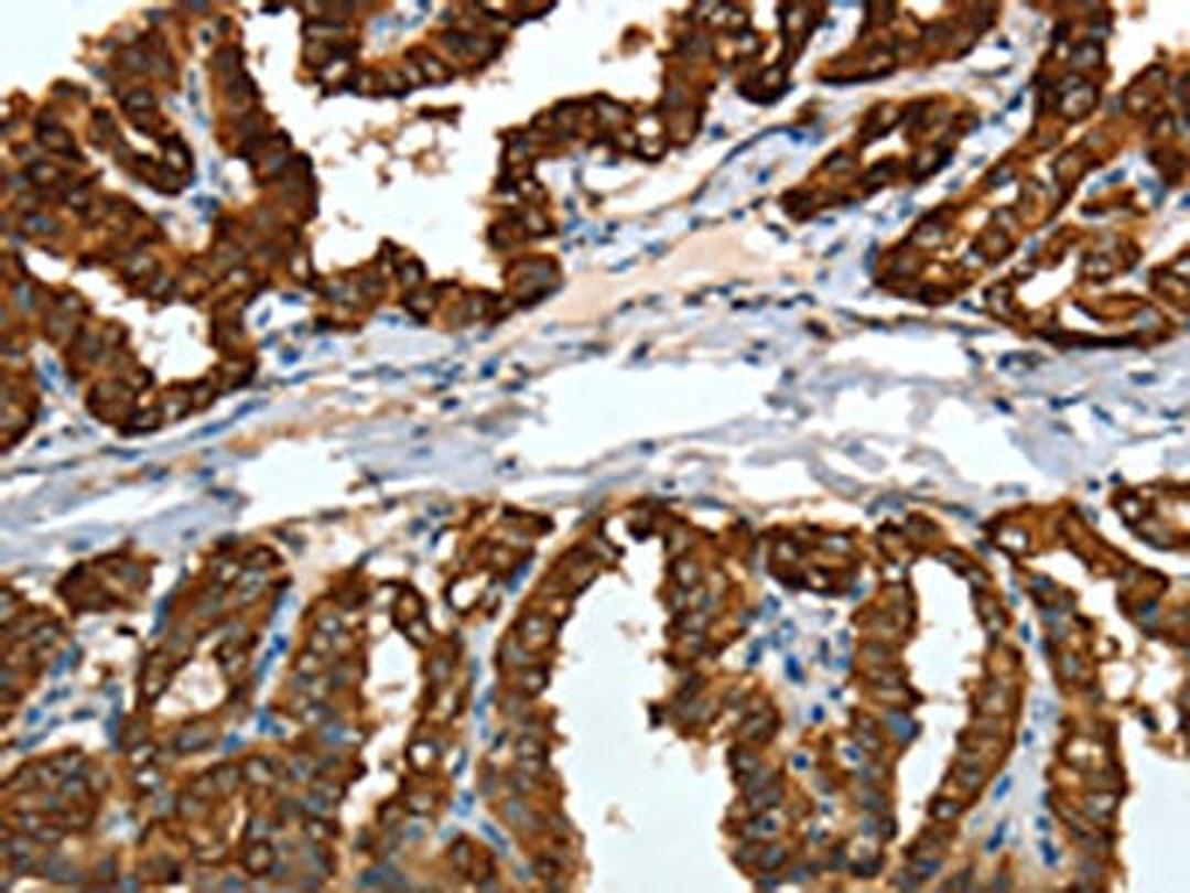 The image on the left is immunohistochemistry of paraffin-embedded Human thyroid cancer tissue using CSB-PA909758(KRT19 Antibody) at dilution 1/15, on the right is treated with fusion protein. (Original magnification: ×200)