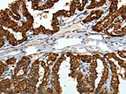 The image on the left is immunohistochemistry of paraffin-embedded Human thyroid cancer tissue using CSB-PA909758(KRT19 Antibody) at dilution 1/15, on the right is treated with fusion protein. (Original magnification: ×200)