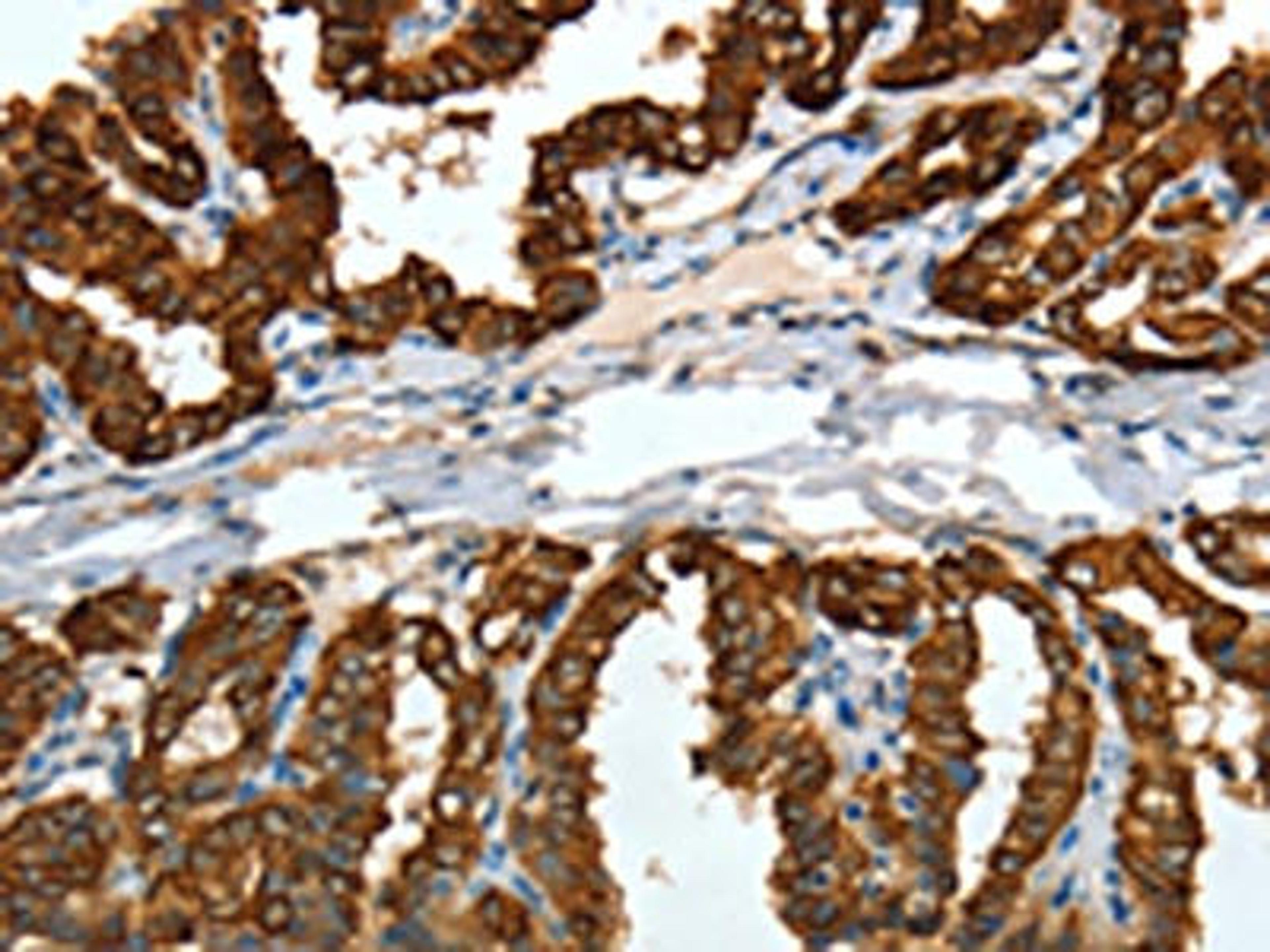 The image on the left is immunohistochemistry of paraffin-embedded Human thyroid cancer tissue using CSB-PA909758(KRT19 Antibody) at dilution 1/15, on the right is treated with fusion protein. (Original magnification: ×200)