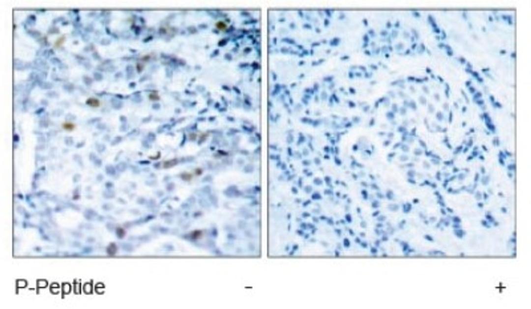 Immunohistochemistry: Cdc2 [p Thr161] Antibody [NB100-81837] - Immunohistochemical analysis of paraffin-embedded human breast carcinoma tissue, using CDC2 (phospho-Thr161) antibody