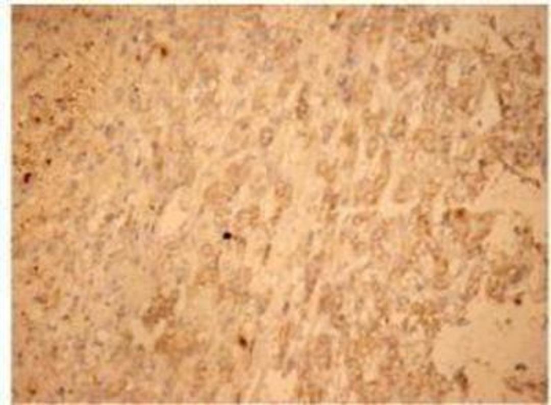 Immunohistochemistry-Paraffin: Fas Antibody [NB120-13550] Staining of human hepatoma tissue with Fas polyclonal antibody.