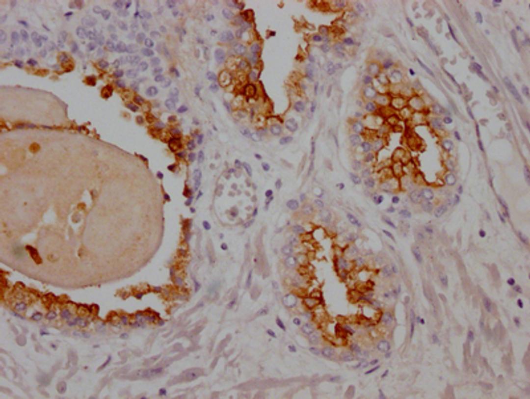 IHC image of CSB-RA162924A0HU diluted at 1:100 and staining in paraffin-embedded human prostate cancer performed on a Leica BondTM system. After dewaxing and hydration, antigen retrieval was mediated by high pressure in a citrate buffer (pH 6.0). Section was blocked with 10% normal goat serum 30min at RT. Then primary antibody (1% BSA) was incubated at 4℃ overnight. The primary is detected by a Goat anti-rabbit IgG polymer labeled by HRP and visualized using 0.05% DAB.