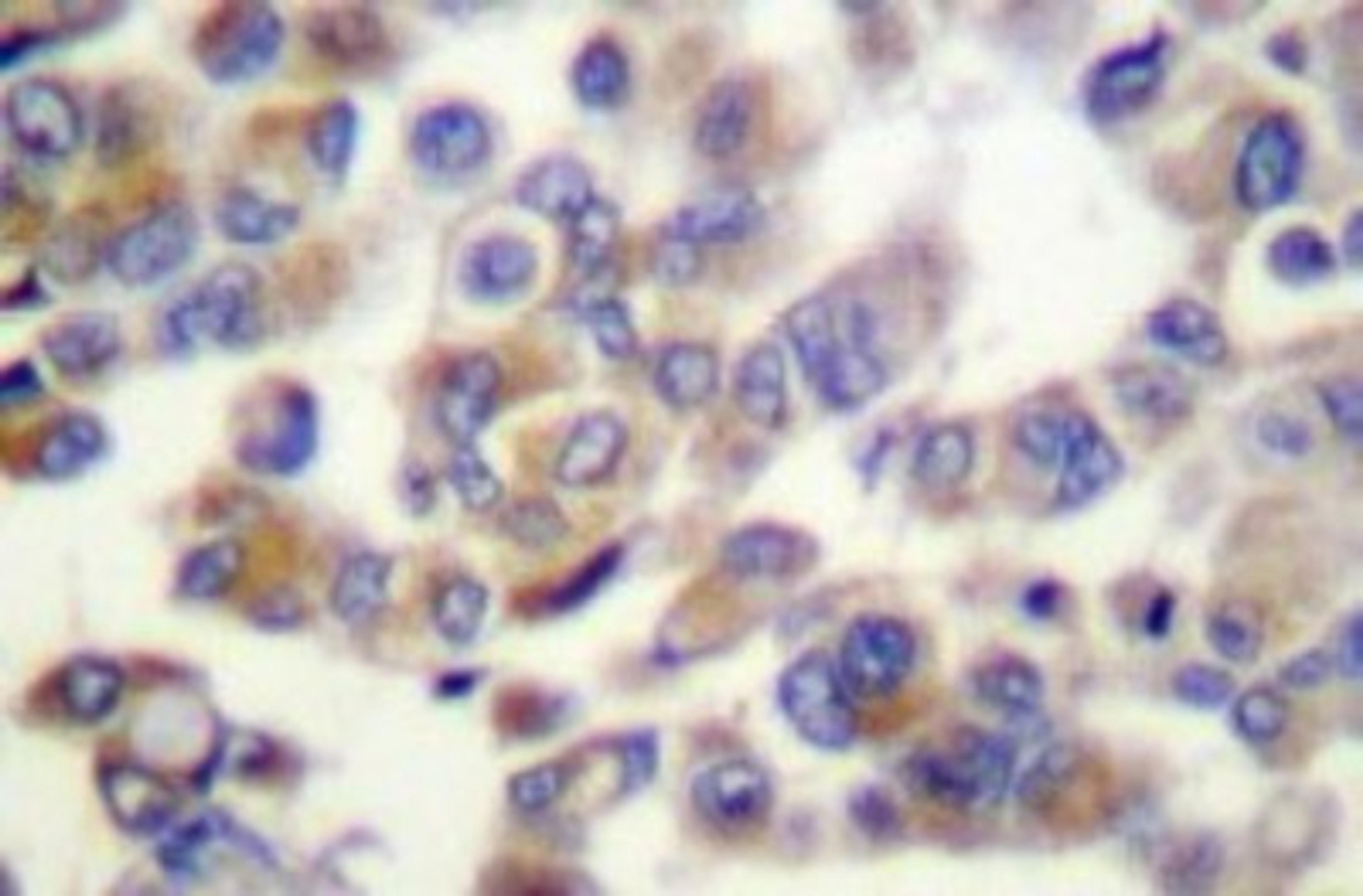 Immunohistochemistry-Paraffin: Wnt1 Antibody [NB100-92262] - Paraffin-embedded human breast  carcinoma tissue.